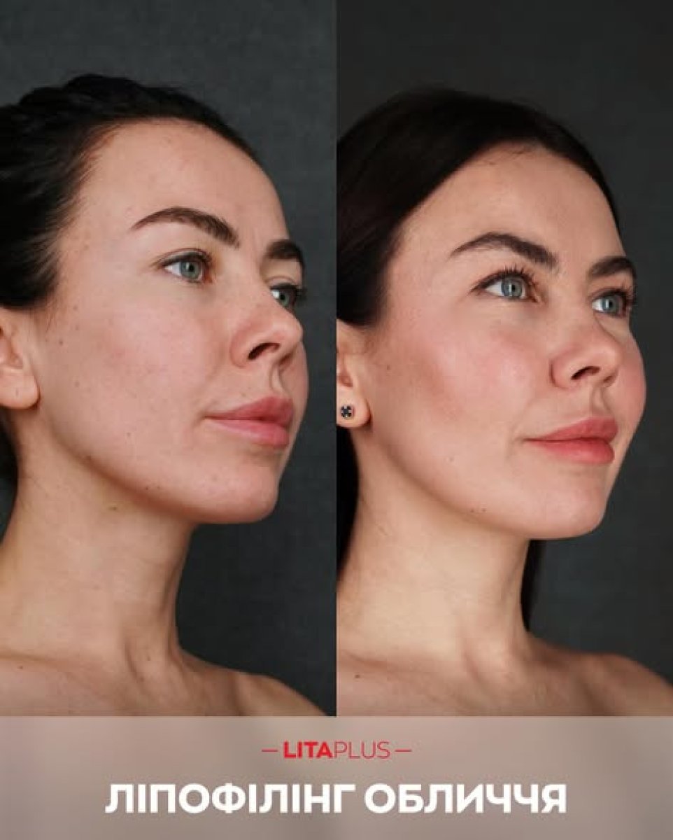 Before and after facial lipofilling results at Lita Plus – enhanced facial volume and contour
