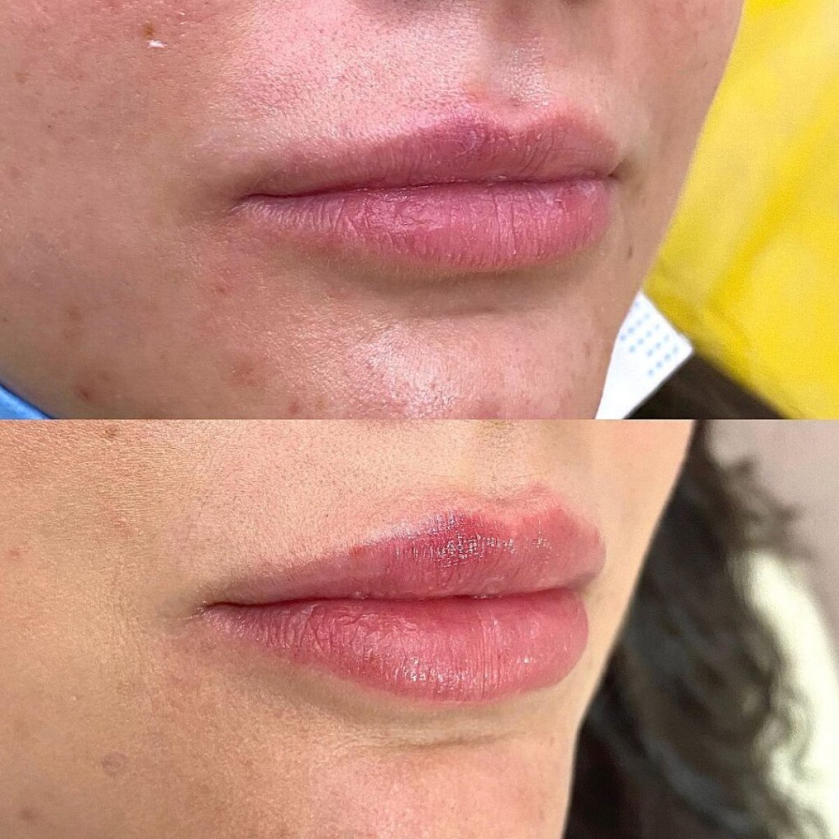 قبل وبعد فيلر الشفاه بحمض الهيالورونيك في Lita Plus، نتيجة تكبير الشفاه