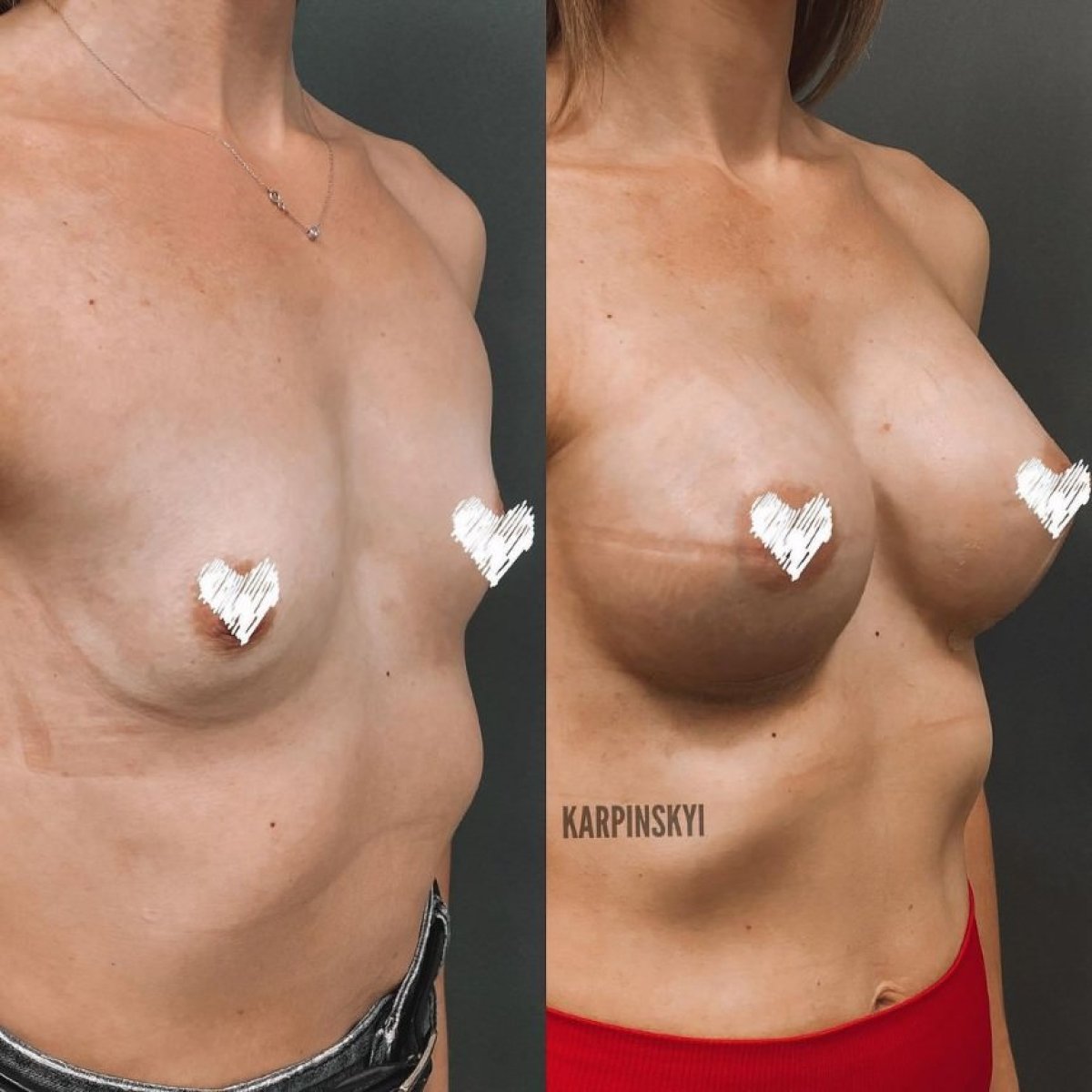 Before and after breast augmentation at Lita Plus, enhanced breast volume and contour result