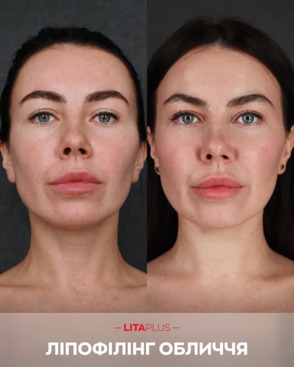 Vorher-nachher-Ergebnis des Gesichts-Lipofillings bei Lita Plus – mehr Volumen und Kontur