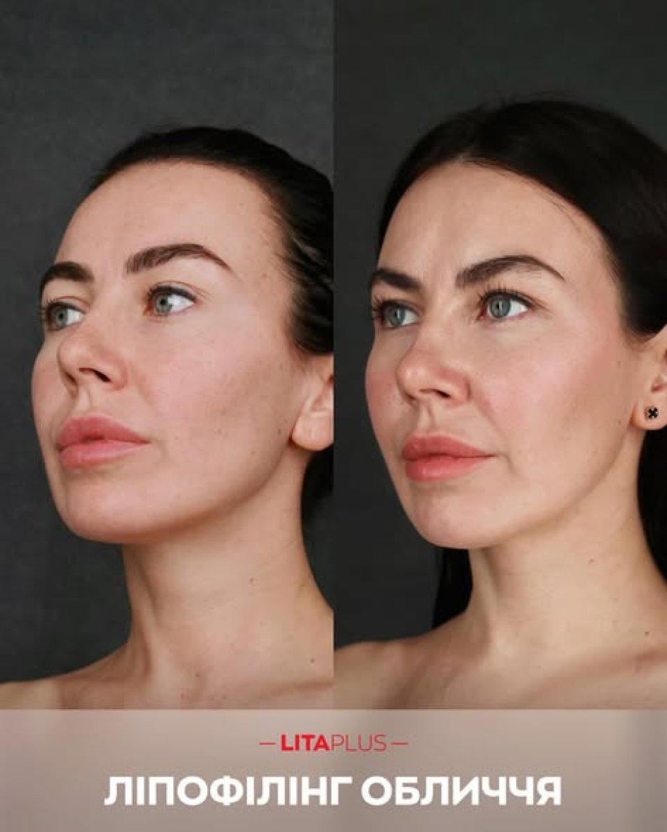 Vorher-nachher-Ergebnis des Gesichts-Lipofillings bei Lita Plus, verbesserte Konturen
