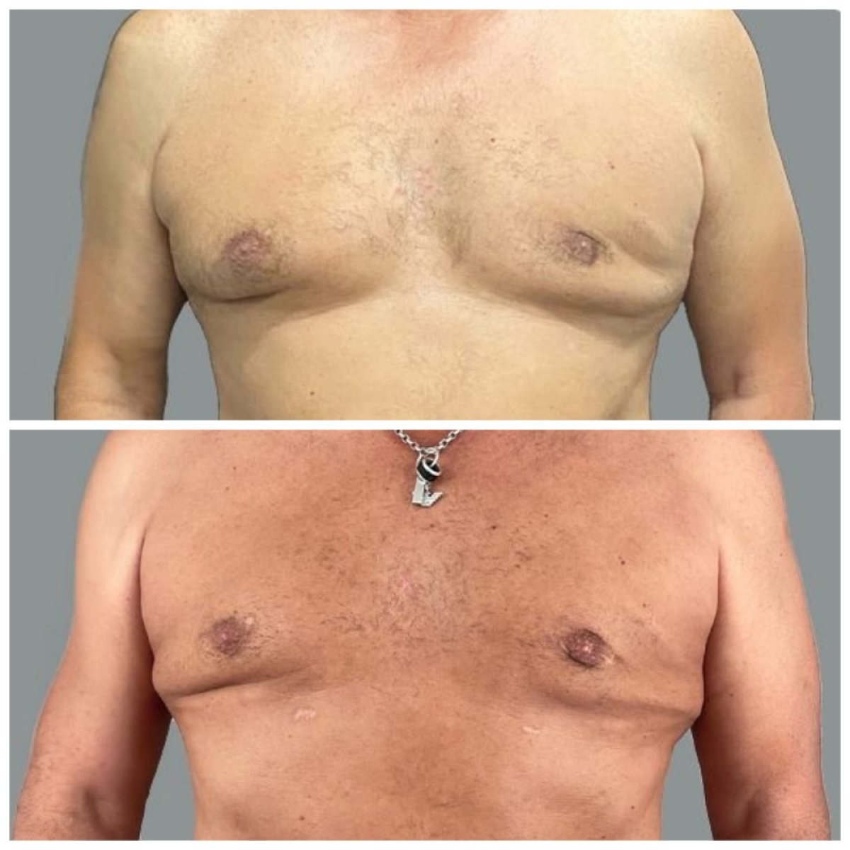 Before and after gynecomastia surgery results at MyMoment – improved male chest contour