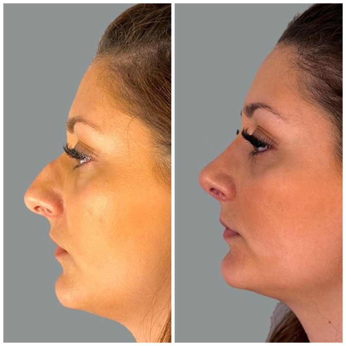 Before and after rhinoplasty result at MyMoment, improved nose shape and profile
