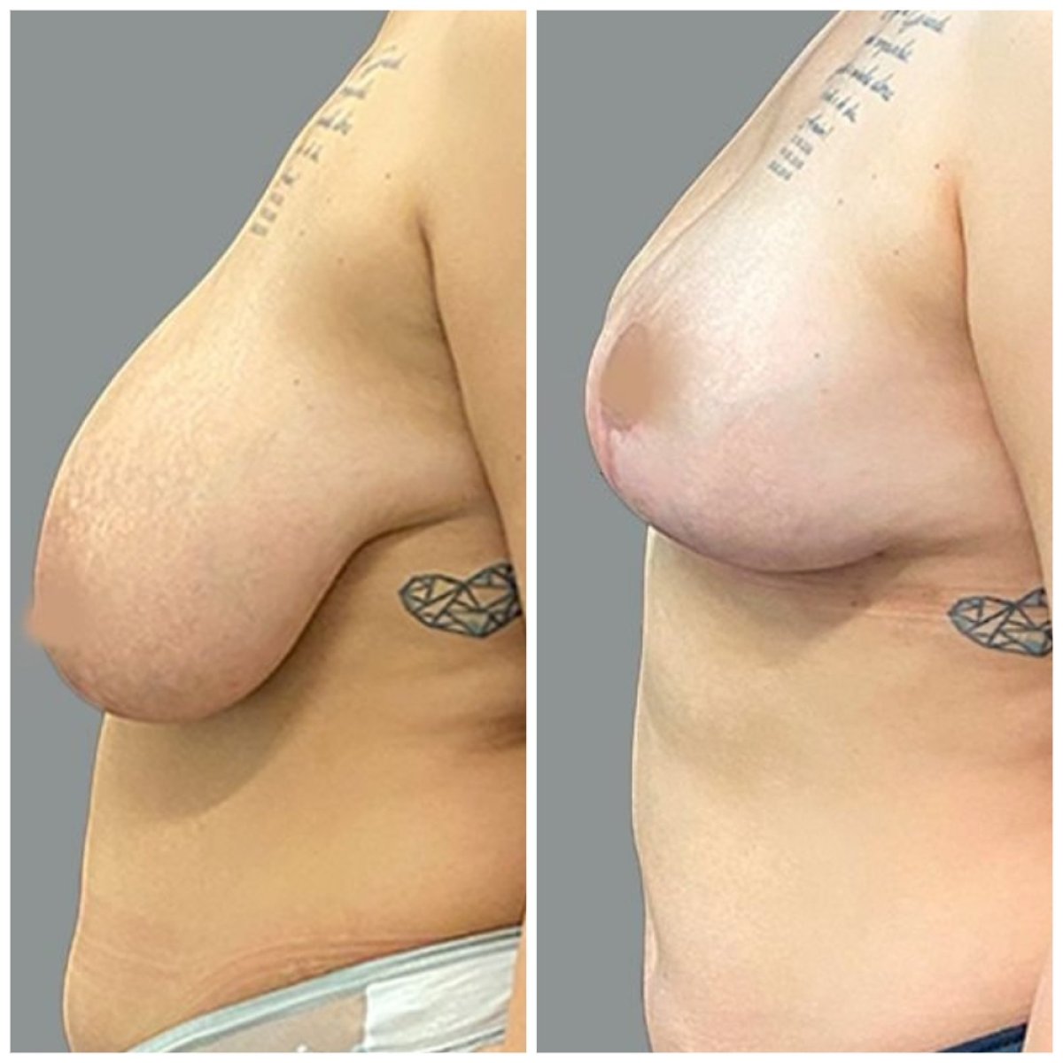 Before and after breast reduction results at MyMoment – improved breast shape and contour