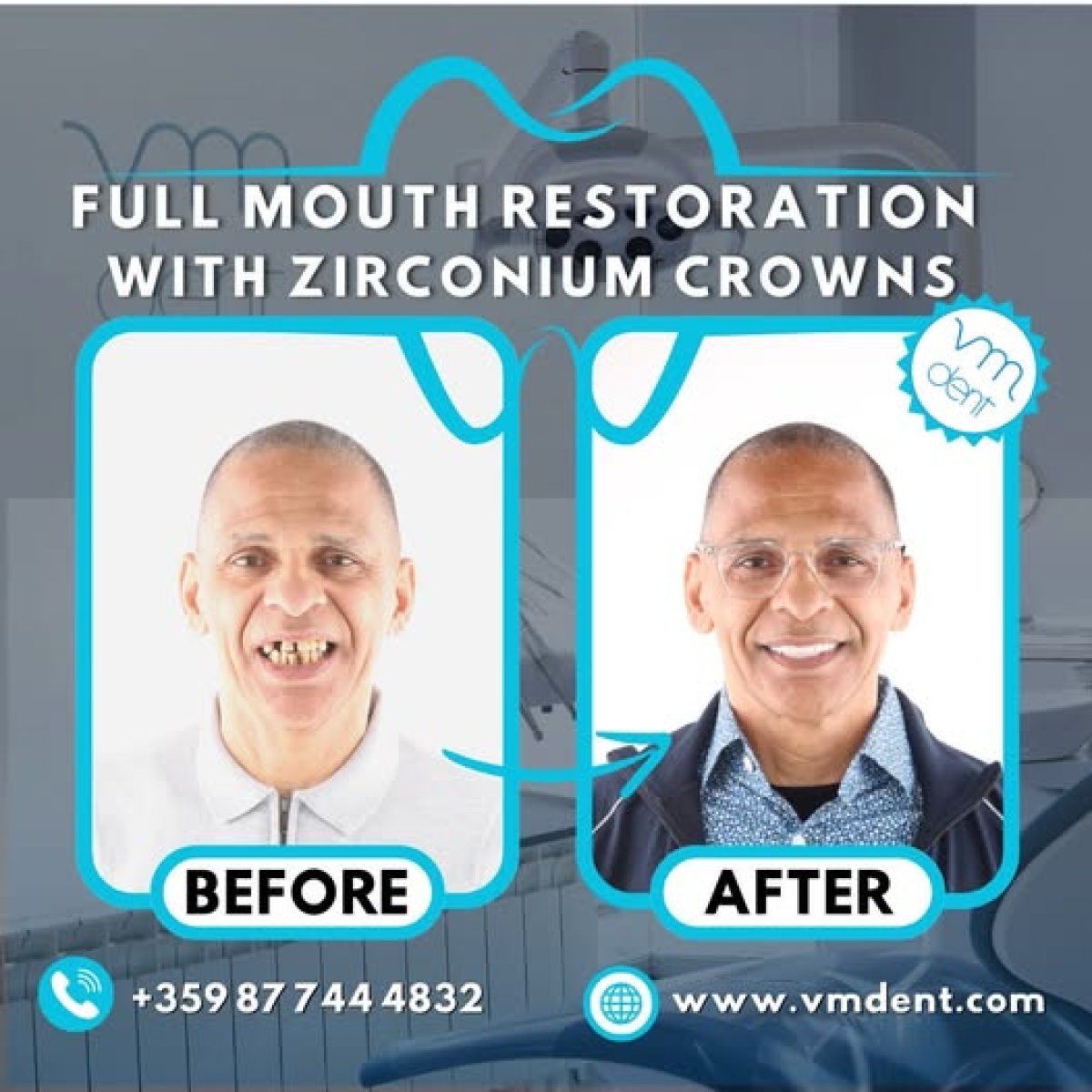 Antes y después de restauración dental total con coronas de zirconio en VM Dent, resultado sonrisa
