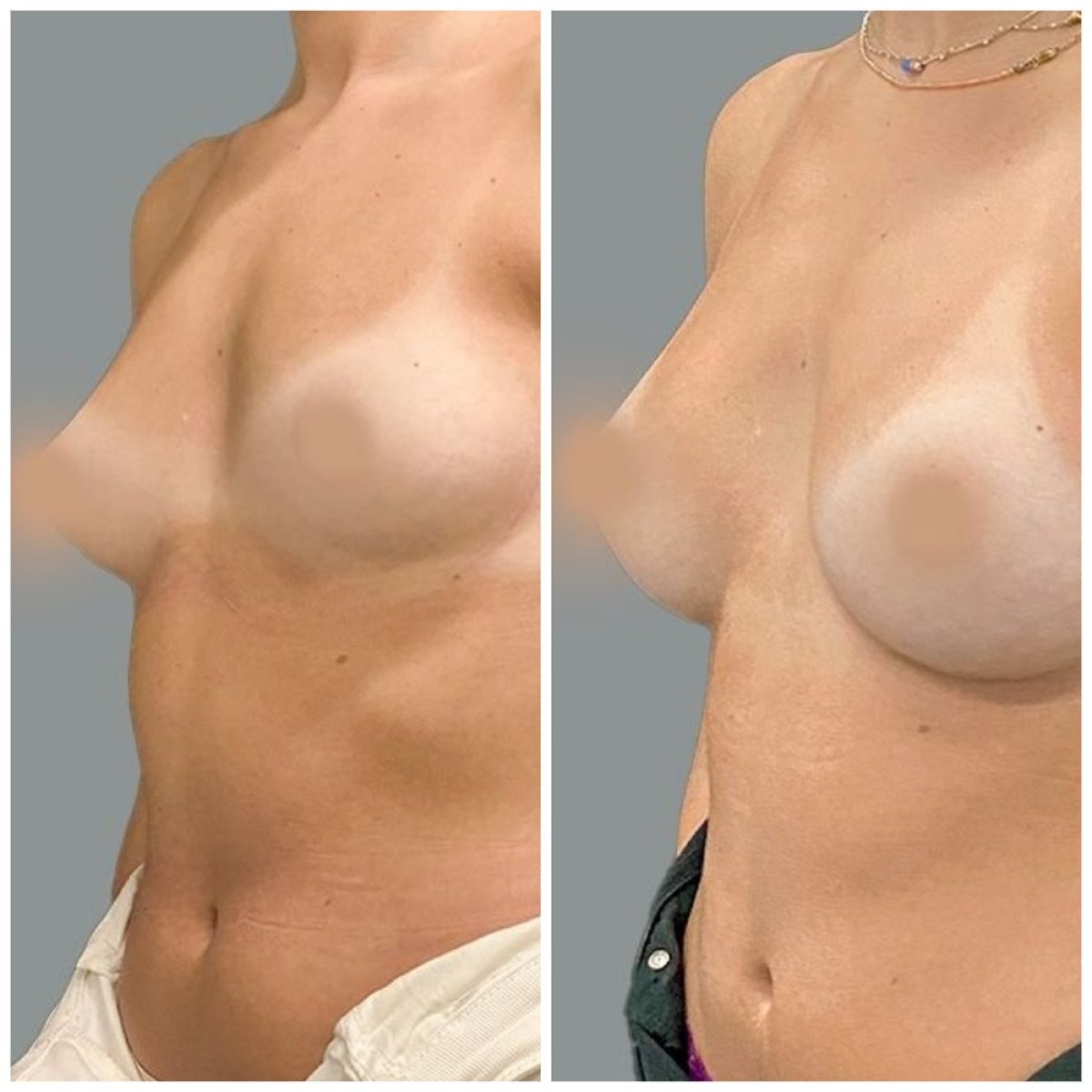 Before and after breast augmentation results at MyMoment – enhanced breast shape and volume