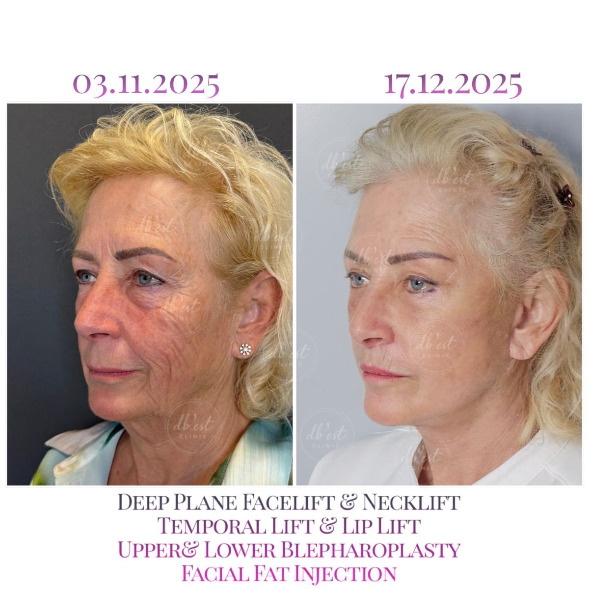 Resultados antes y después de lifting facial, cuello y blefaroplastia en Db'est Clinic