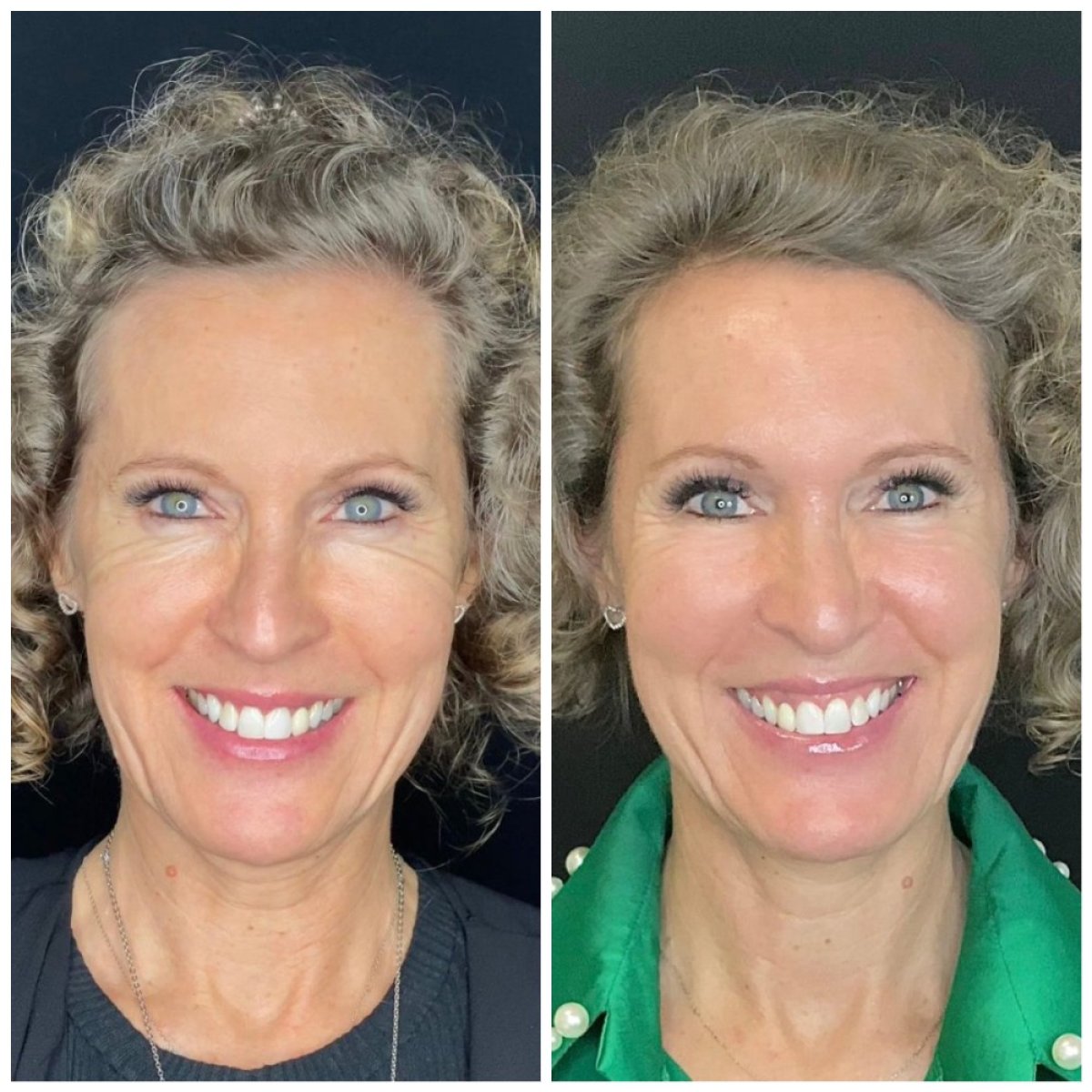 Facelift Vorher-Nachher-Ergebnis bei MyMoment – glatteres, verjüngtes Gesicht