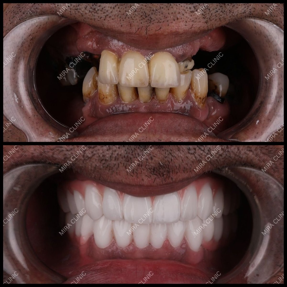 Resultados antes y después de implantes dentales All-on-6 en Mira Clinic, sonrisa restaurada