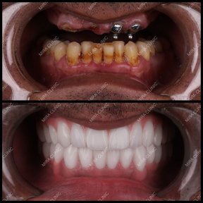 Basic All-on-6 Dental Implants - photo 4
