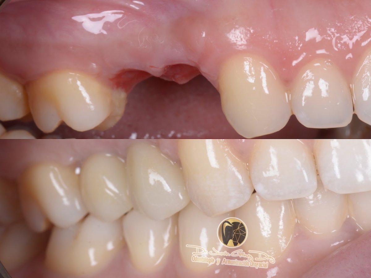 Before and after dental implant with crown at Dr. Junen Gómez, restored natural smile result