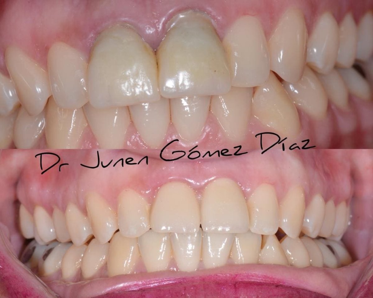 Resultados de blanqueamiento dental antes y después en Dr. Junen Gómez – sonrisa más brillante