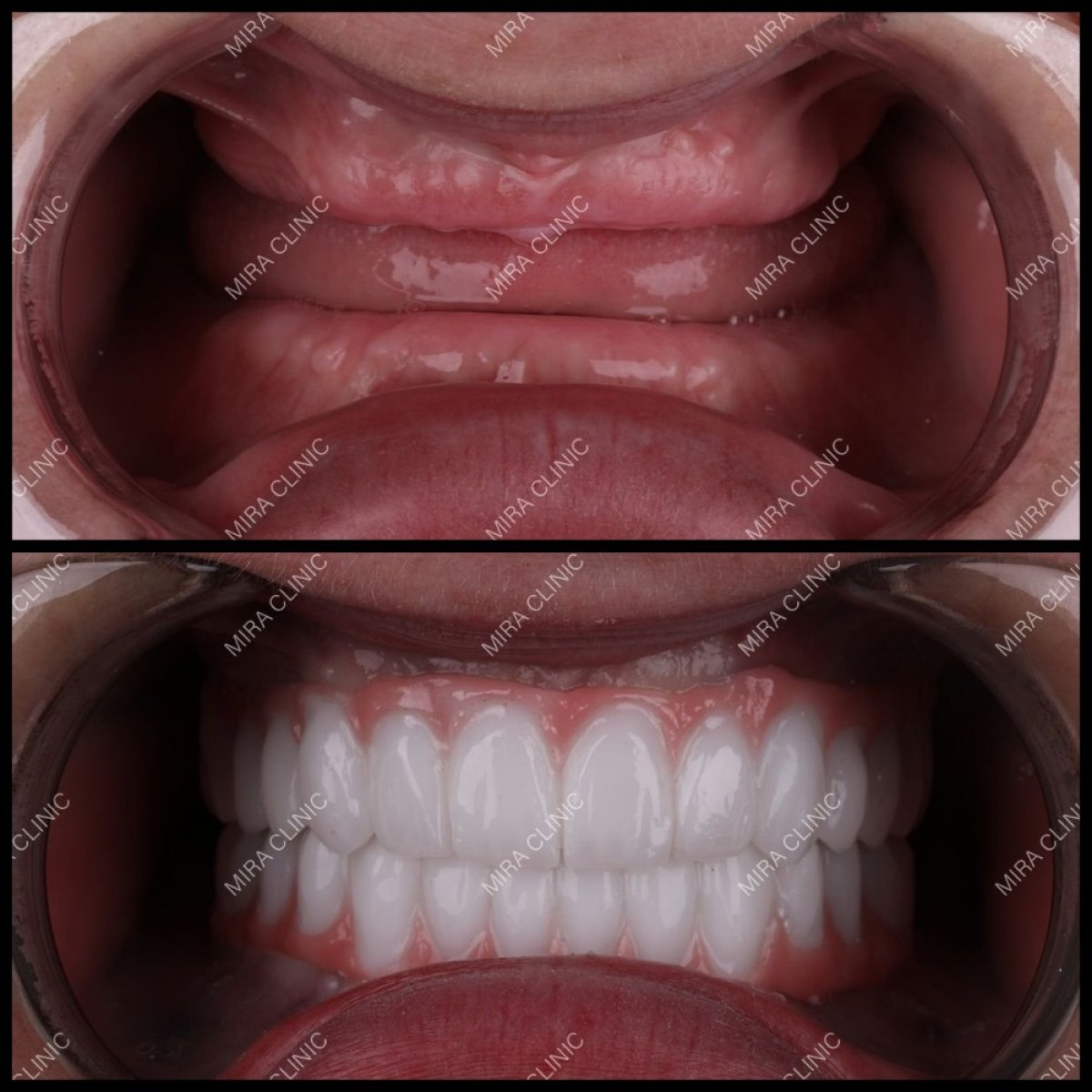 Resultado antes y después de implantes dentales All-on-6 en Mira Clinic, restauración total