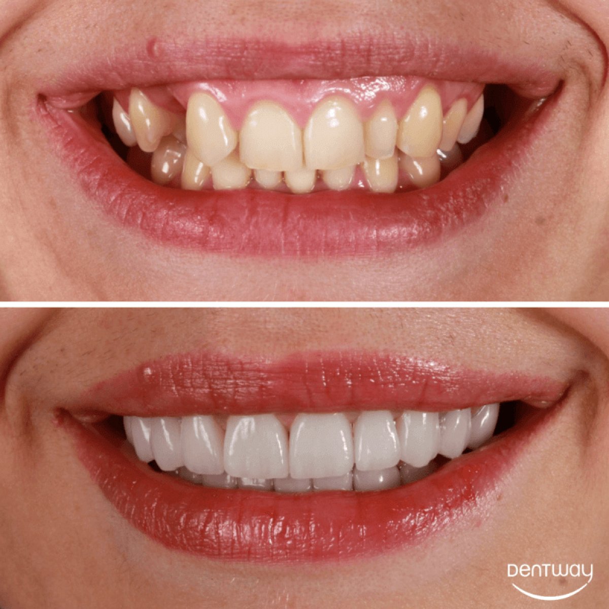 Before and after Hollywood Smile results at Dentway International – dental veneers transformation