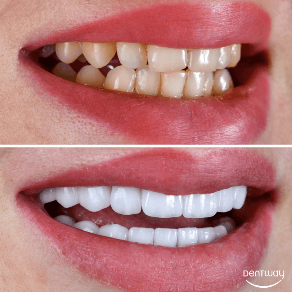 Before and after Hollywood Smile results at Dentway International – dental veneers transformation