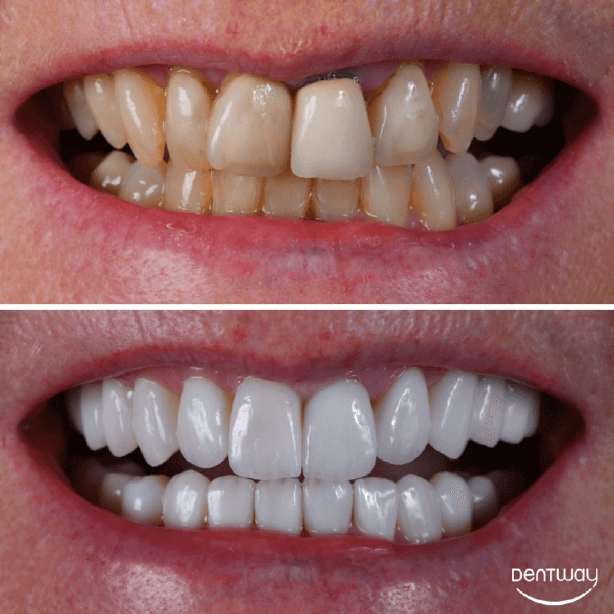 Résultat avant-après facettes Hollywood Smile chez Dentway International, transformation visible du sourire