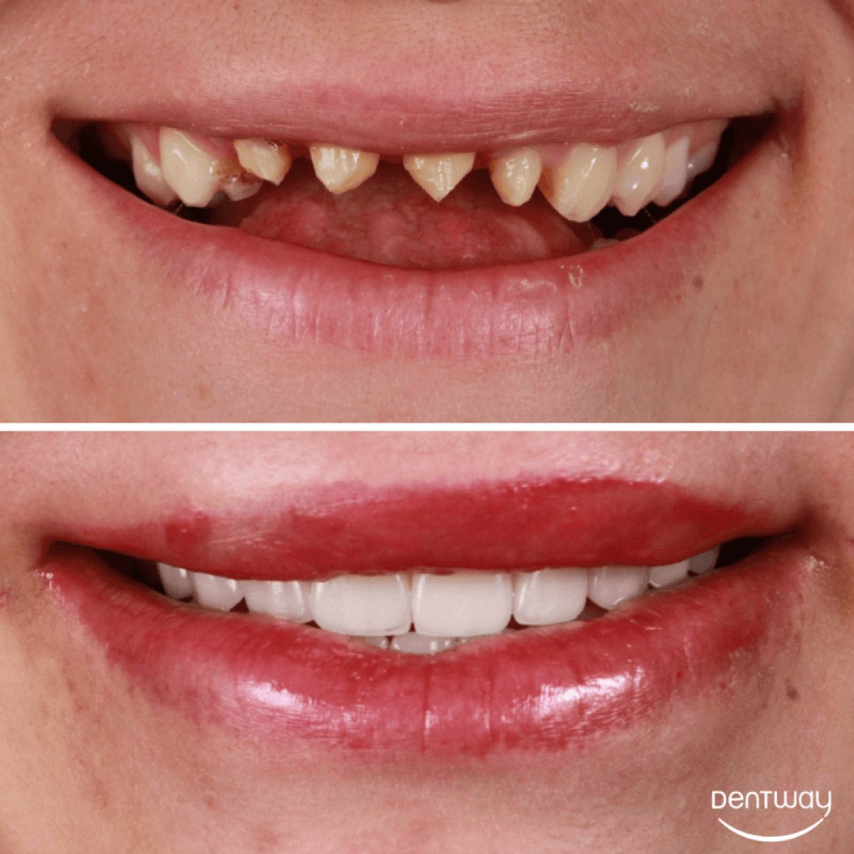 Résultats avant et après facettes en porcelaine chez Dentway International – transformation du sourire