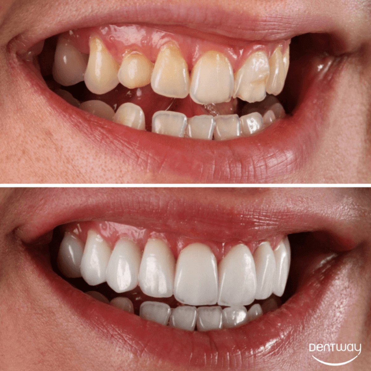 Before and after veneers at Dentway International – smile transformation and whiter teeth result