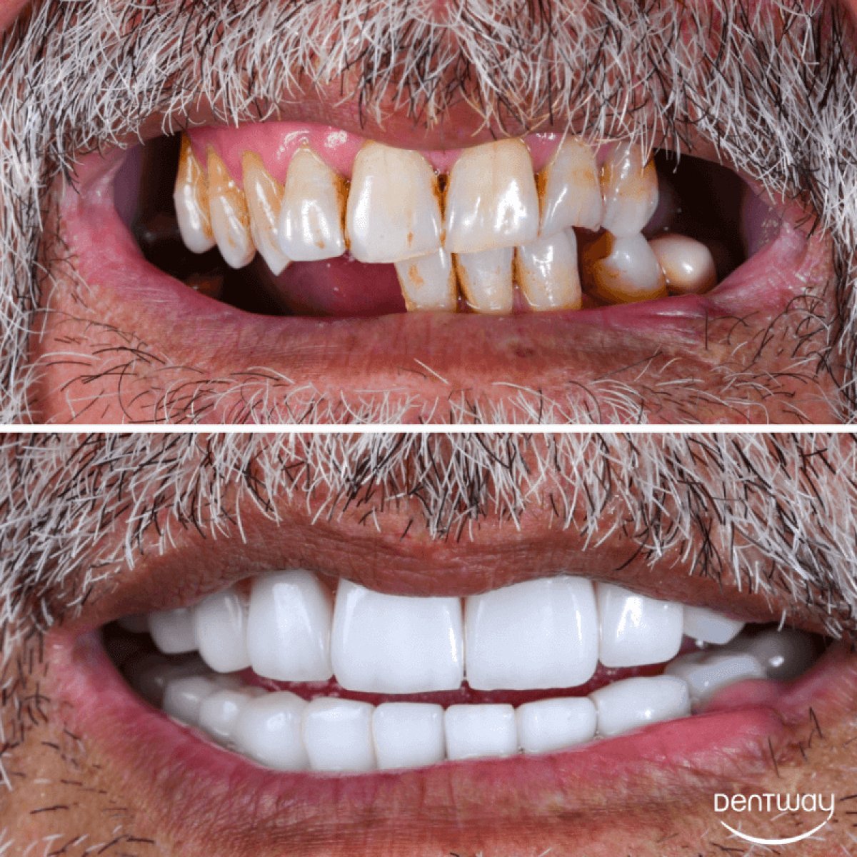 Before and after veneers at Dentway International – dramatic smile transformation result