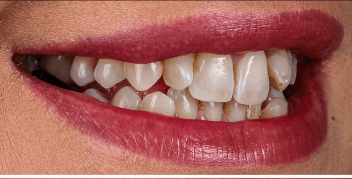 Tooth whitening result at Dentway International – visibly brighter smile after treatment