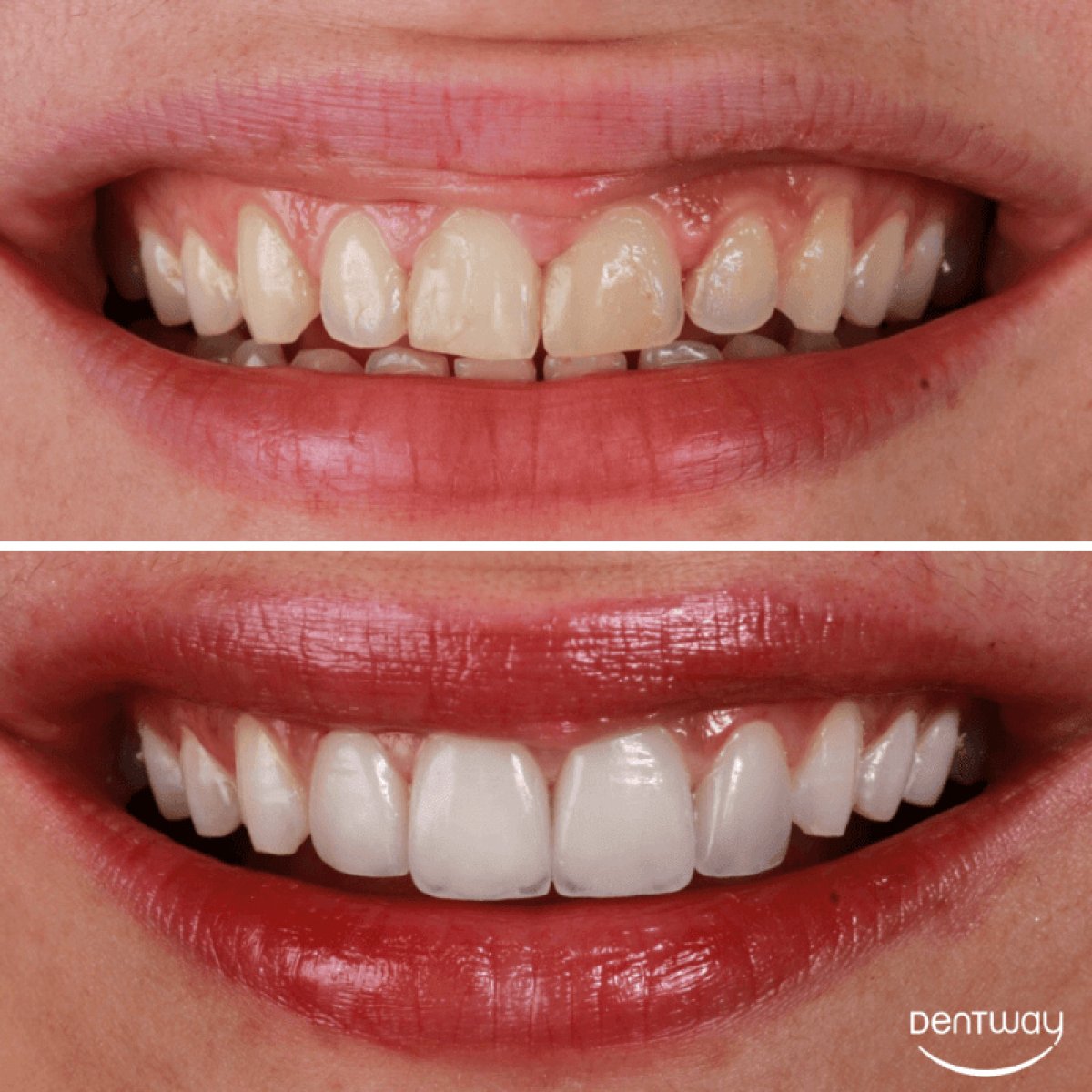 Resultados antes y después del blanqueamiento dental en Dentway International – sonrisa más blanca
