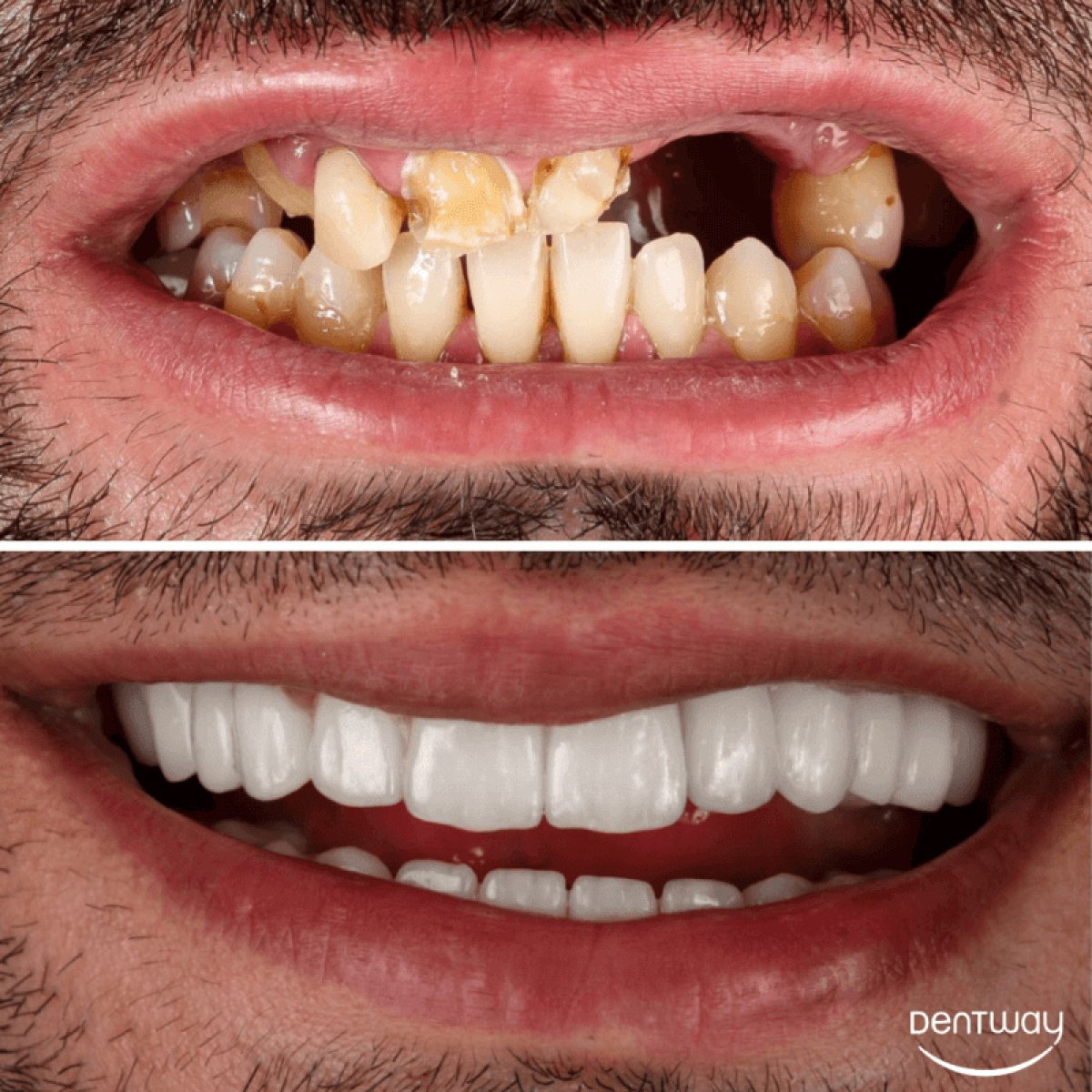 Before and after dental restoration at Dentway International – full smile makeover results