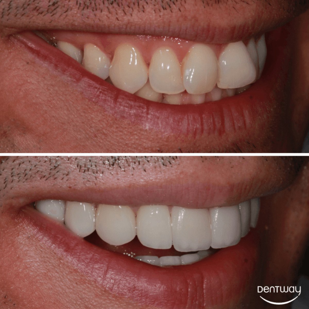 Antes y después de carillas dentales en Dentway International, resultado de sonrisa mejorada