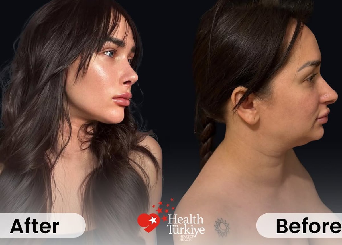 Before and after rhinoplasty results at Dr.Fatih Çınar clinic, nose reshaping and profile improvement