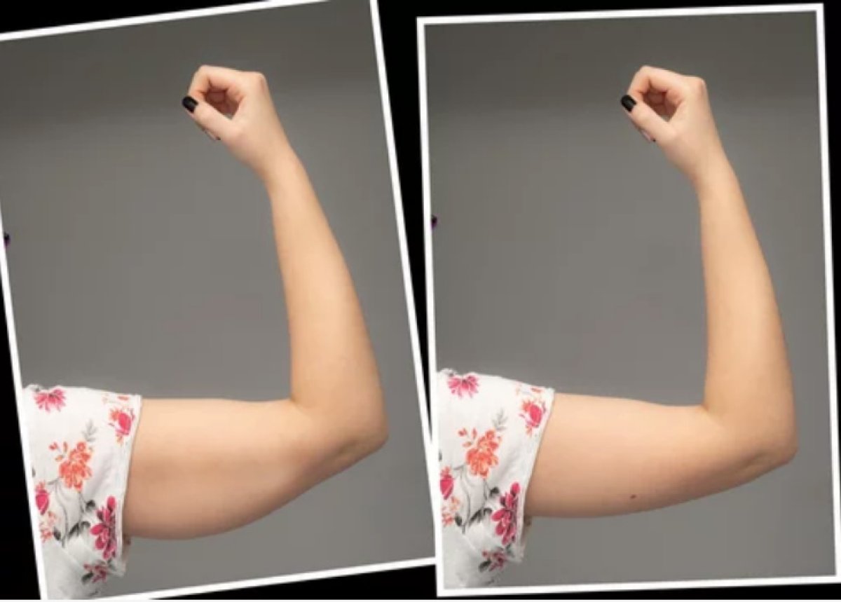 Résultat avant/après lifting des bras (brachioplastie) chez Dr.Fatih Çınar – contour amélioré
