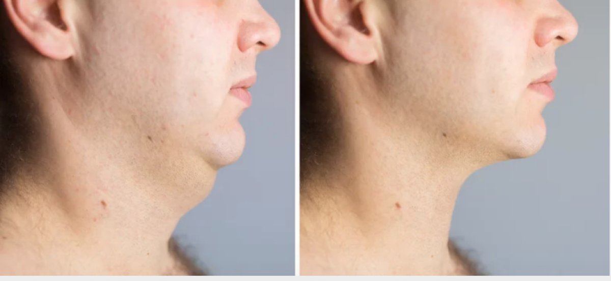 Before and after neck liposuction results at Dr.Fatih Çınar clinic, improved jawline contour