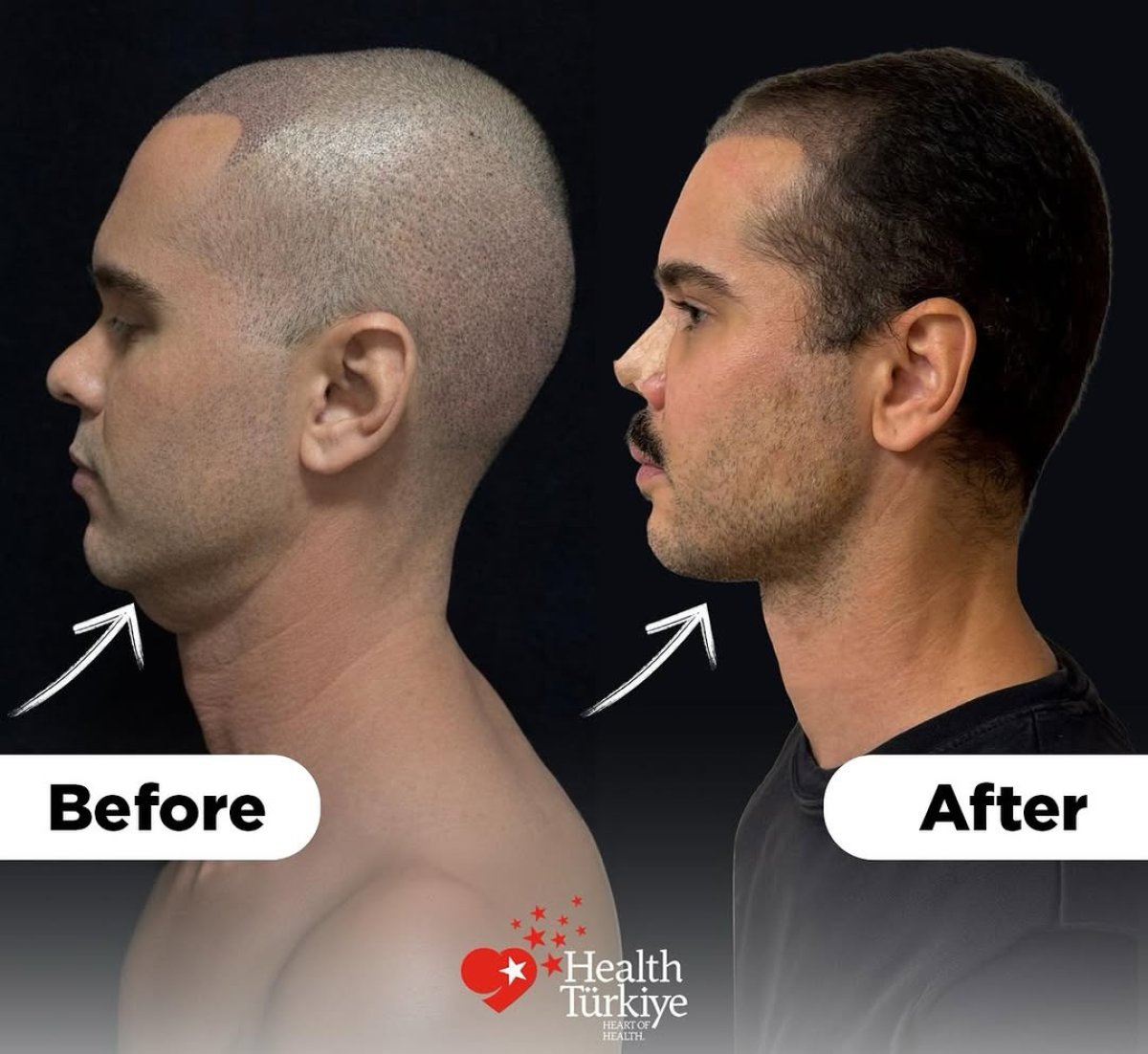 Before and after neck lift results at Dr.Fatih Çınar clinic, improved jawline contour