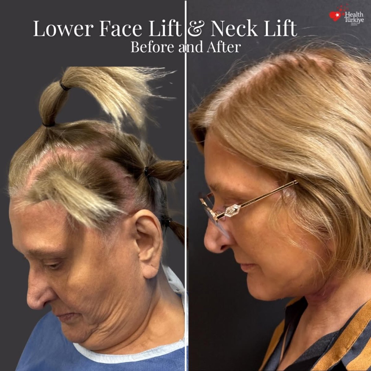 Before and after neck lift results at Dr.Fatih Çınar clinic, visible neck and jawline tightening