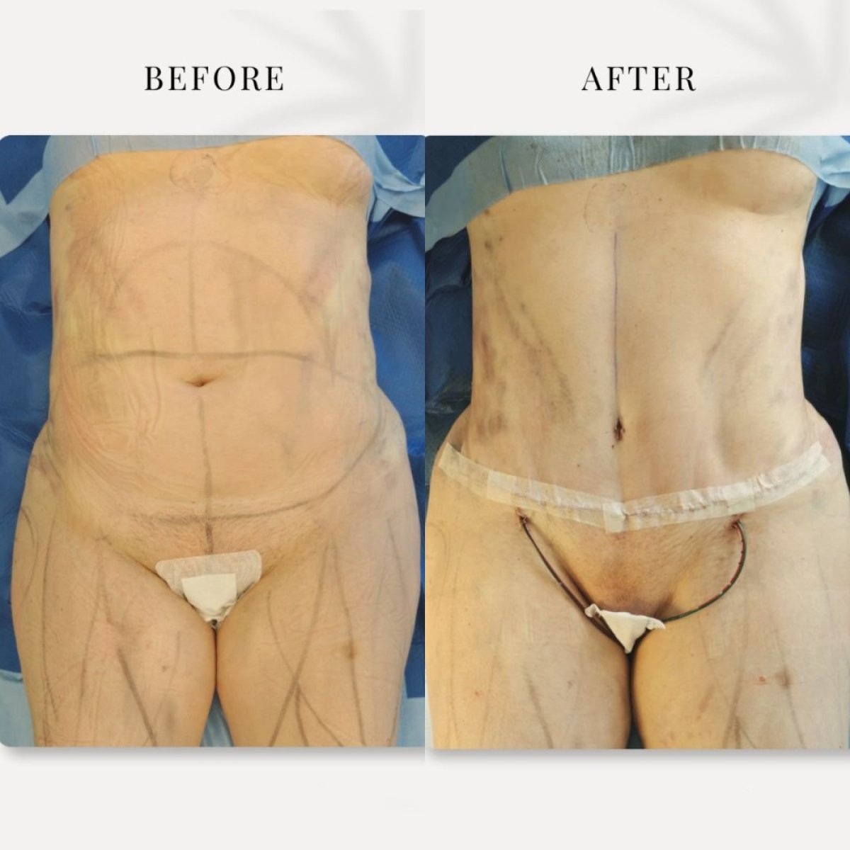 Resultados de abdominoplastia antes y después en Meliva Kardiolita Hospital, contorno visible
