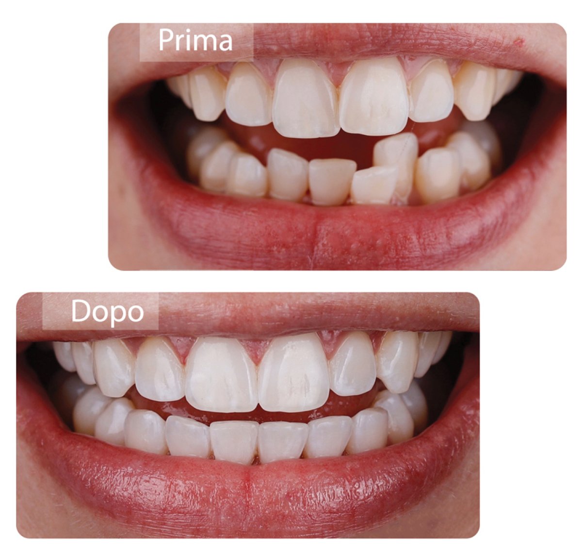 Before and after Invisalign results at Gremi Clinic – straighter teeth and improved smile