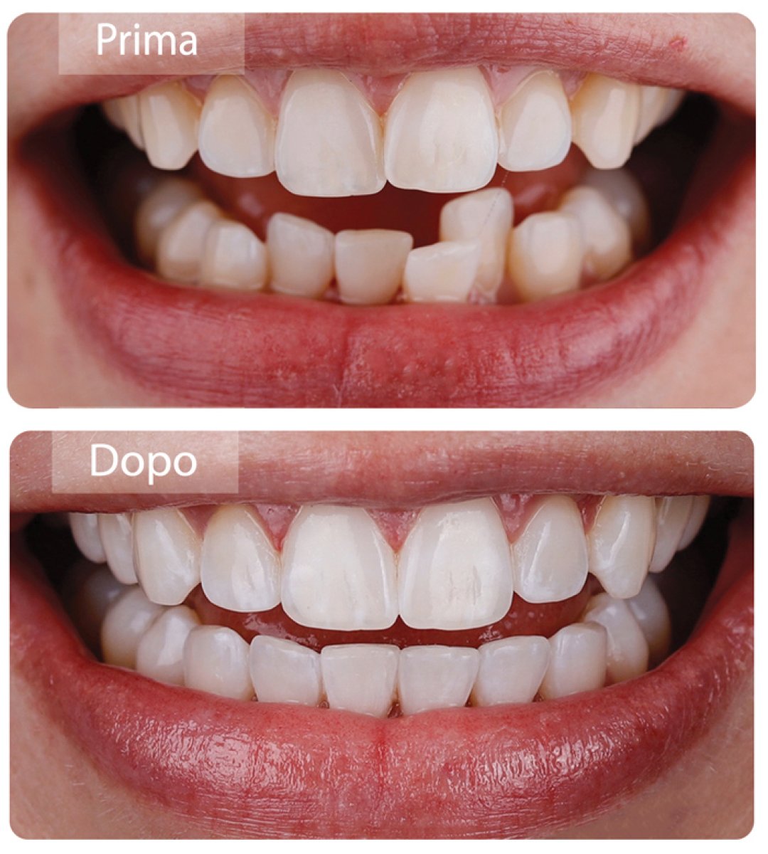 Before and after Invisalign results at Gremi Clinic – straighter teeth and improved smile