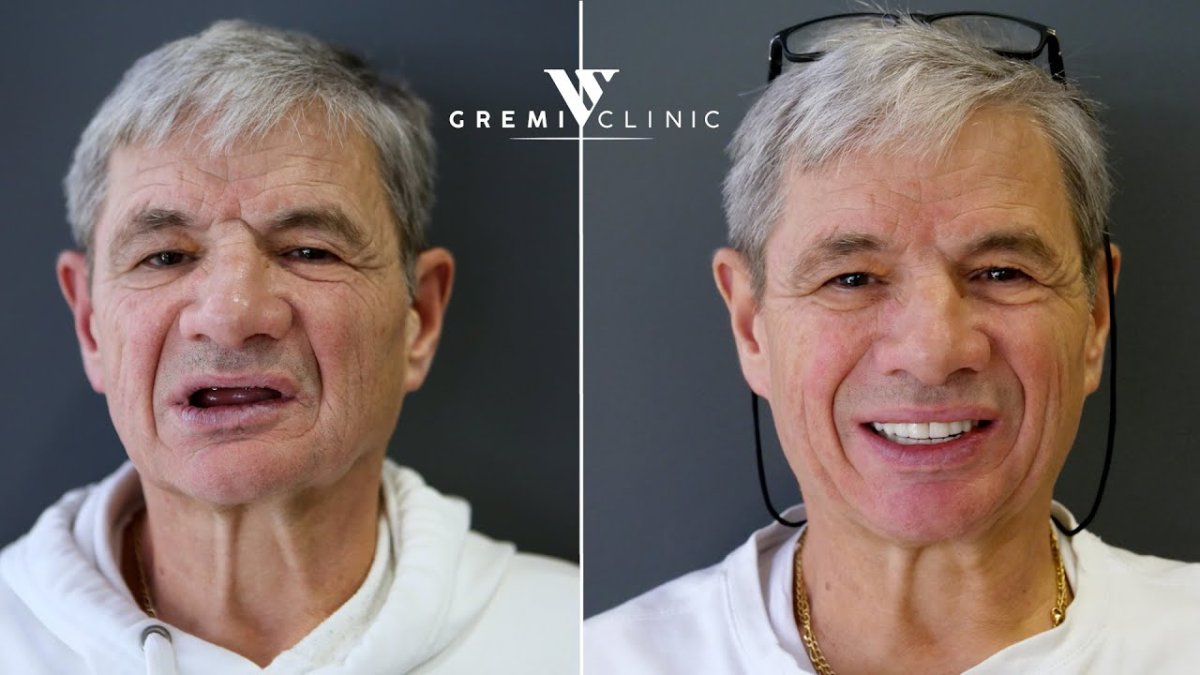 До и после установки зубного импланта с коронкой в Gremi Clinic, восстановленная улыбка