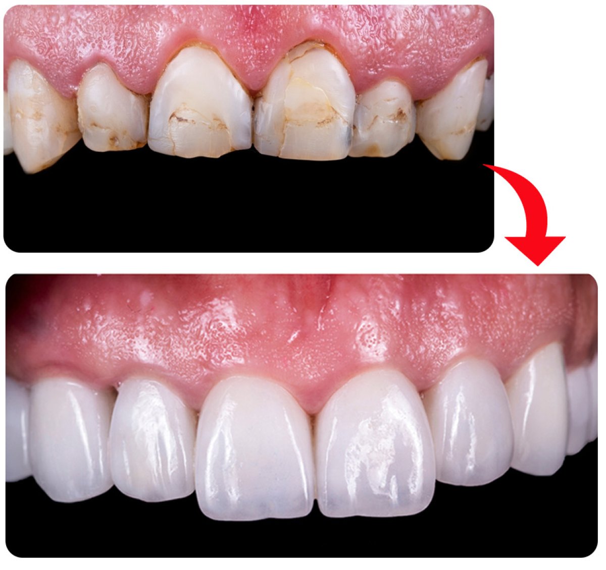 Before and after instant veneers at Gremi Clinic, smile transformation with natural results