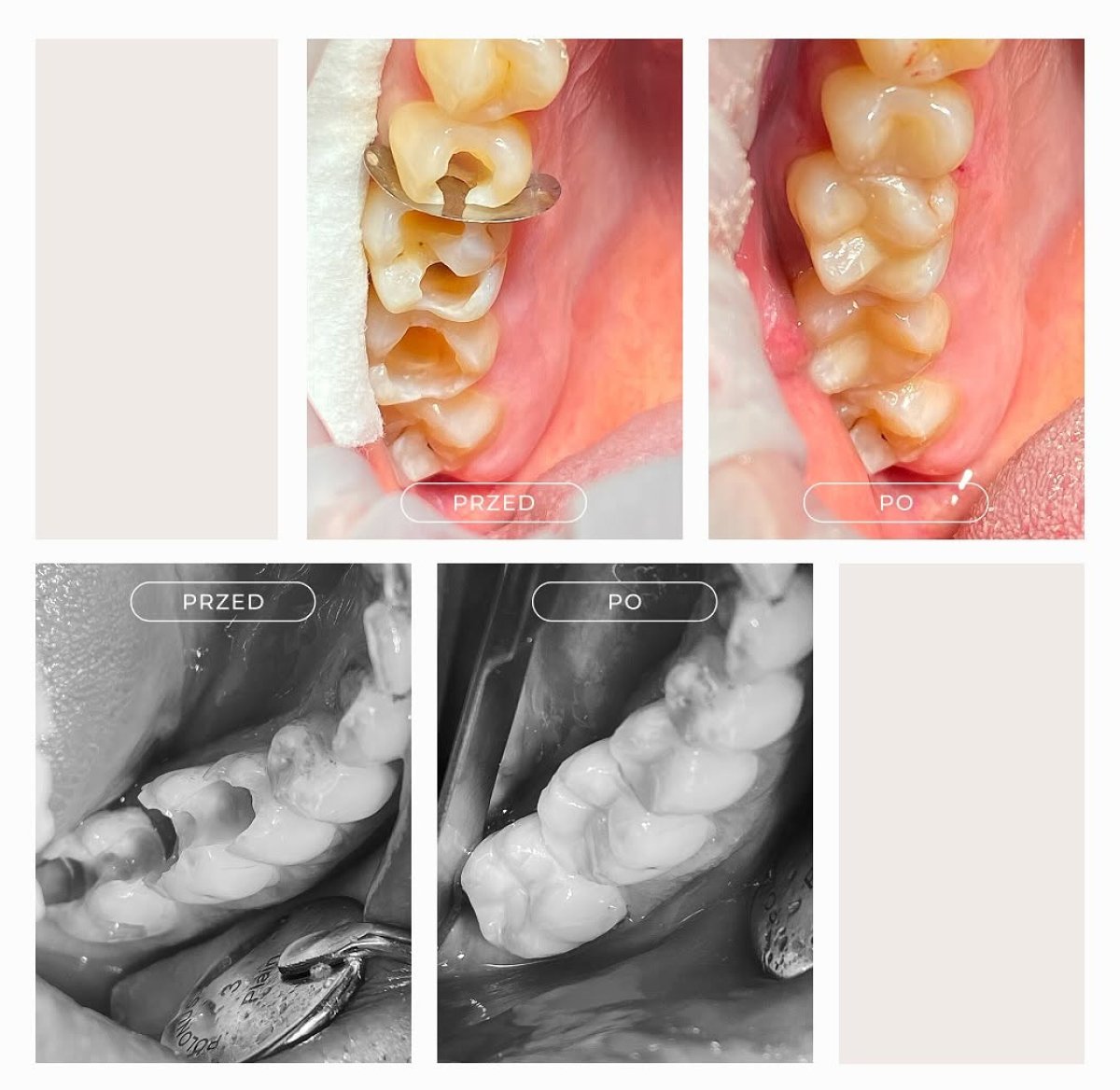 Before and after results of caries treatment at Lekarze w Warszawie, restored tooth surfaces