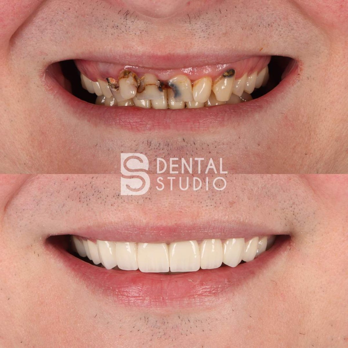 Vorher-nachher-Ergebnis Smile Makeover bei BS Dental Studio – vollständige Zahnsanierung