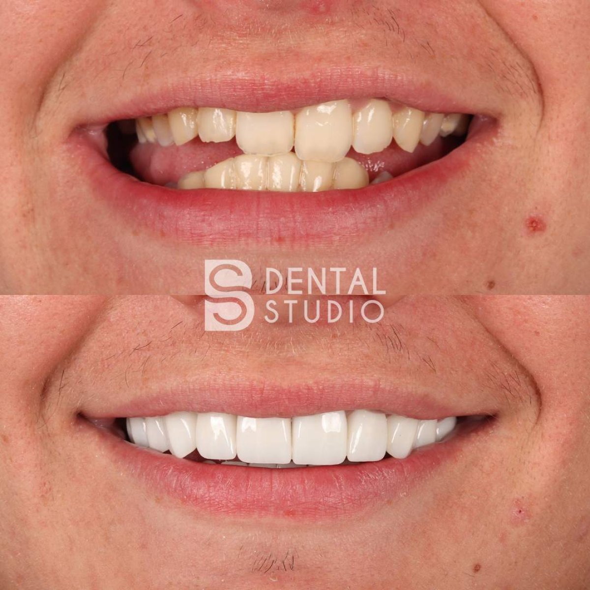 Before and after smile makeover results at BS Dental Studio with dental veneers transformation