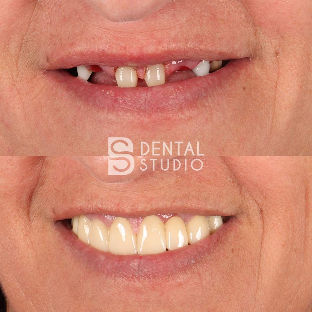 Smile Makeover Vorher-Nachher-Ergebnisse bei BS Dental Studio – restaurierte Zähne, verbesserte Lächeln