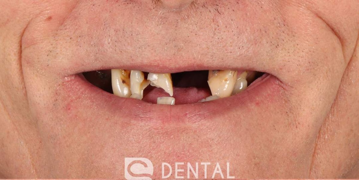 Dents gravement abîmées avant implants dentaires chez BS Dental Studio, restauration du sourire