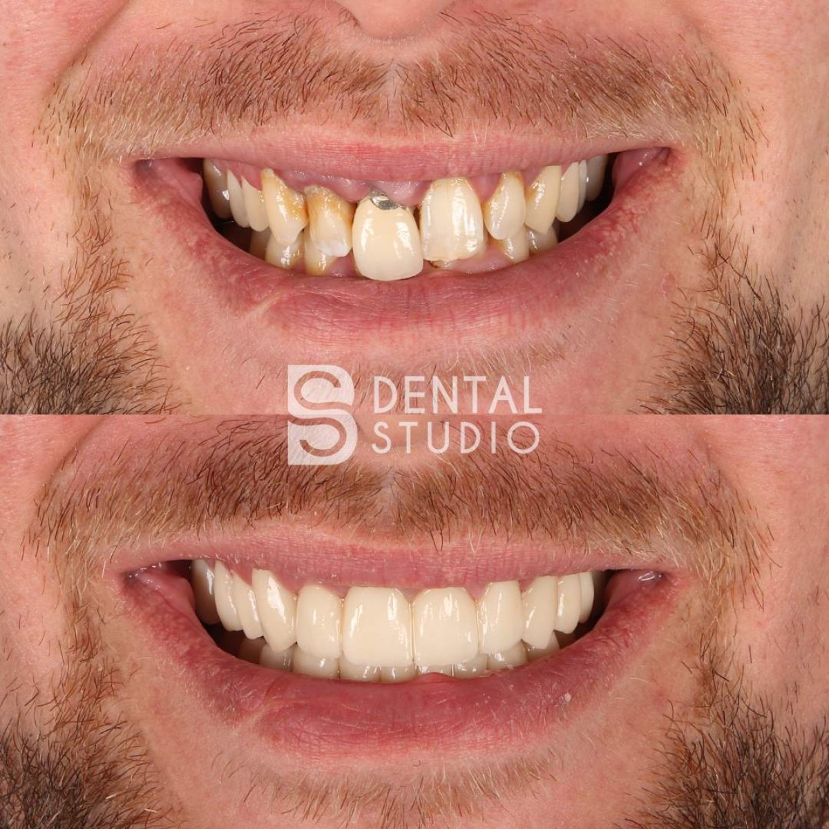 Vorher-nachher-Ergebnis Zahnkronen bei BS Dental Studio, verbesserte Ästhetik des Lächelns