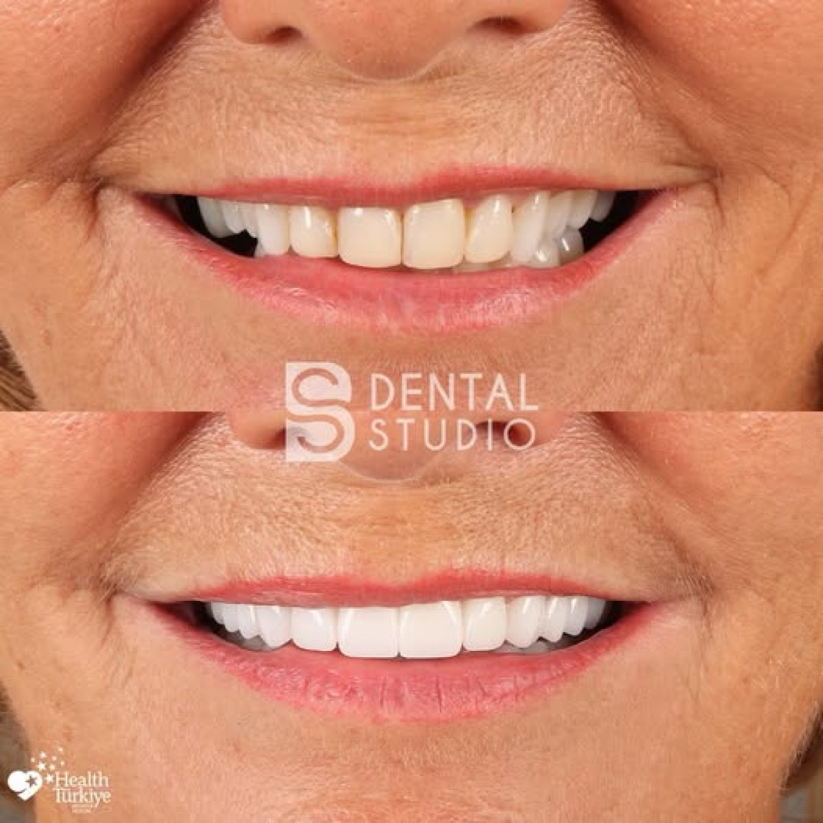 Результаты до и после установки коронок в BS Dental Studio, улучшение эстетики улыбки