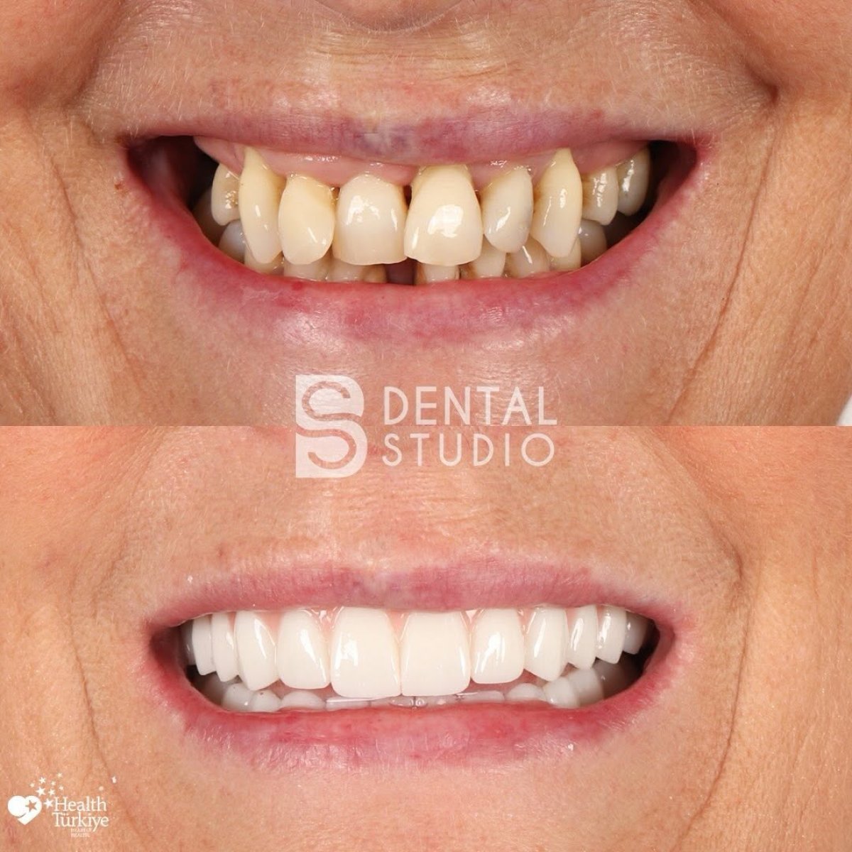 Vorher-nachher-Ergebnis Zahnkronen bei BS Dental Studio – Lächeln wiederhergestellt