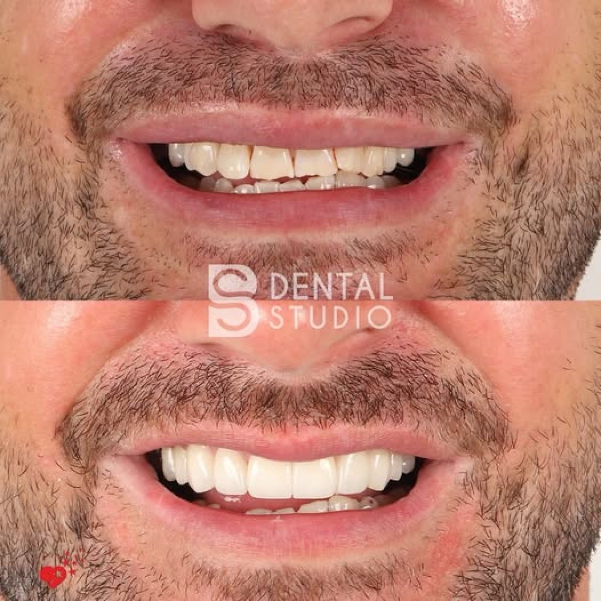 Résultats avant et après pose de couronnes dentaires chez BS Dental Studio, sourire amélioré