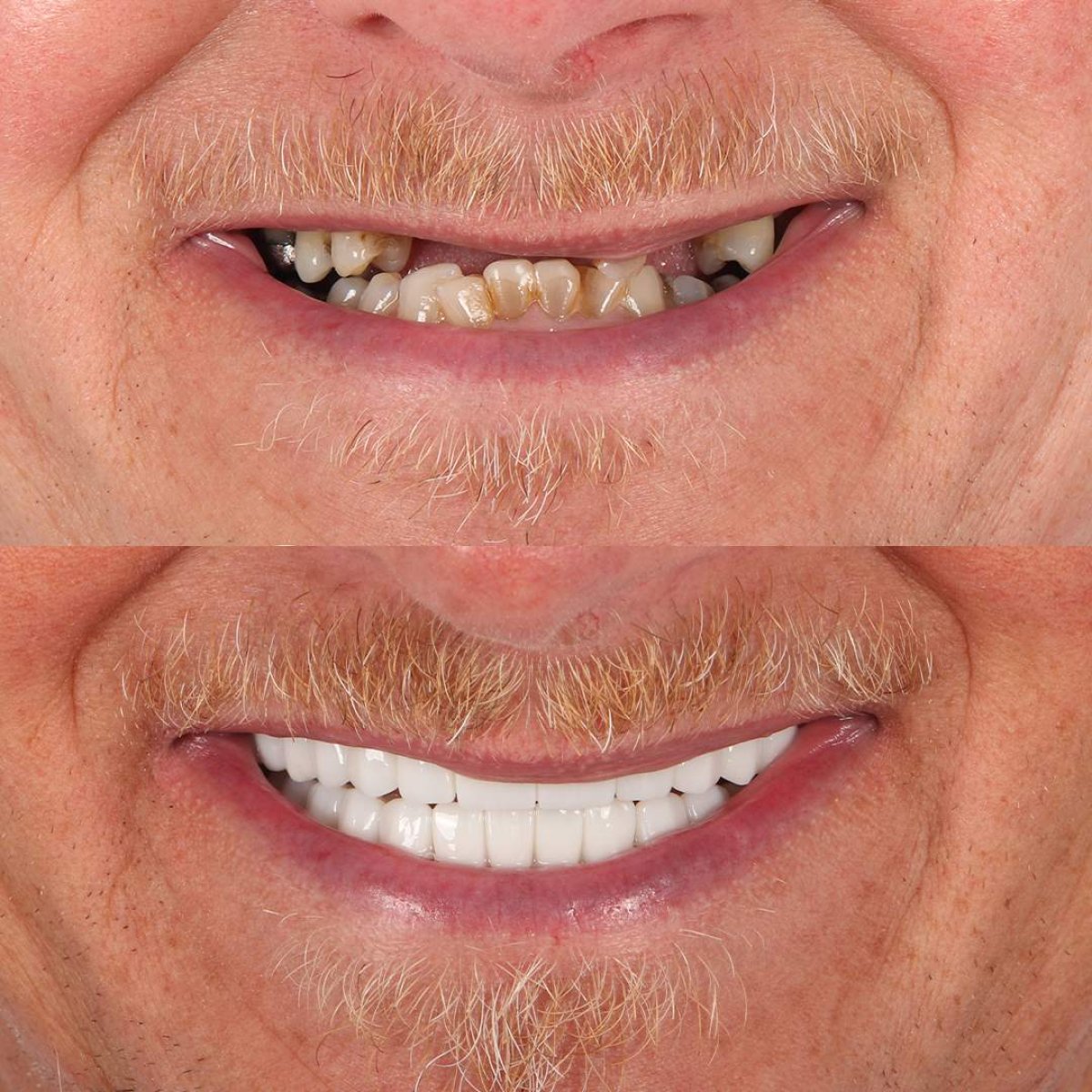 Before and after Hollywood Smile results at BS Dental Studio – full smile makeover with veneers
