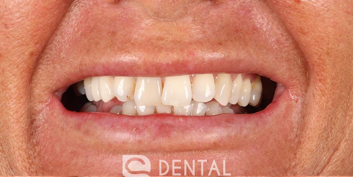 Hollywood Smile result at BS Dental Studio – improved teeth alignment and whiter smile