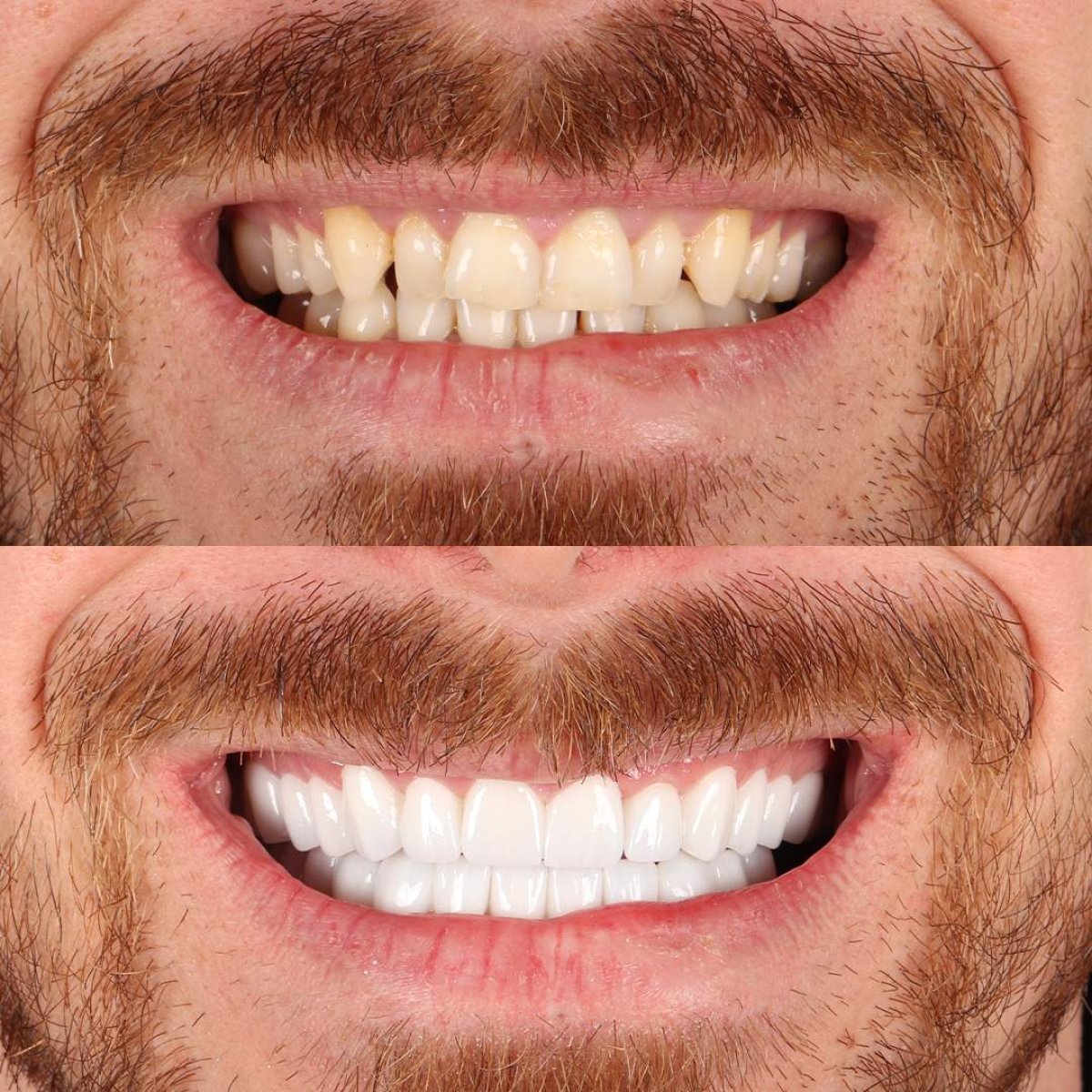 Before and after tooth whitening results at BS Dental Studio – visibly brighter smile transformation