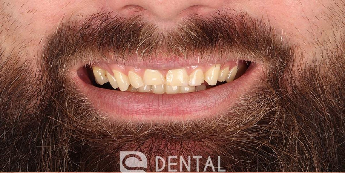 До відбілювання зубів у BS Dental Studio, видно жовтуваті зуби до результату